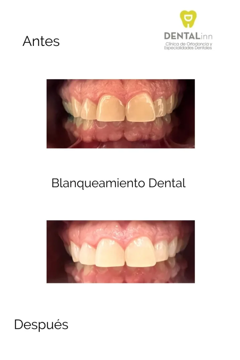 Blanqueamiento dental: dientes frontales antes y después
