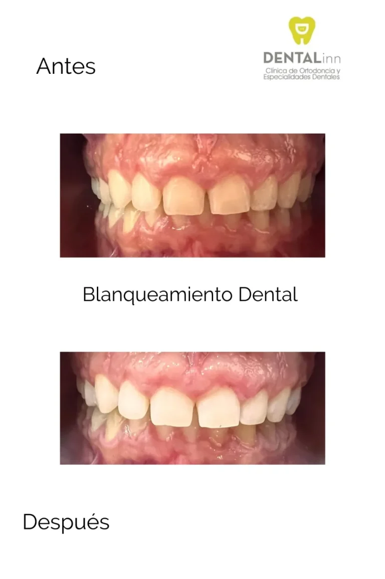Resultado de blanqueamiento dental en Dental Inn, antes y después