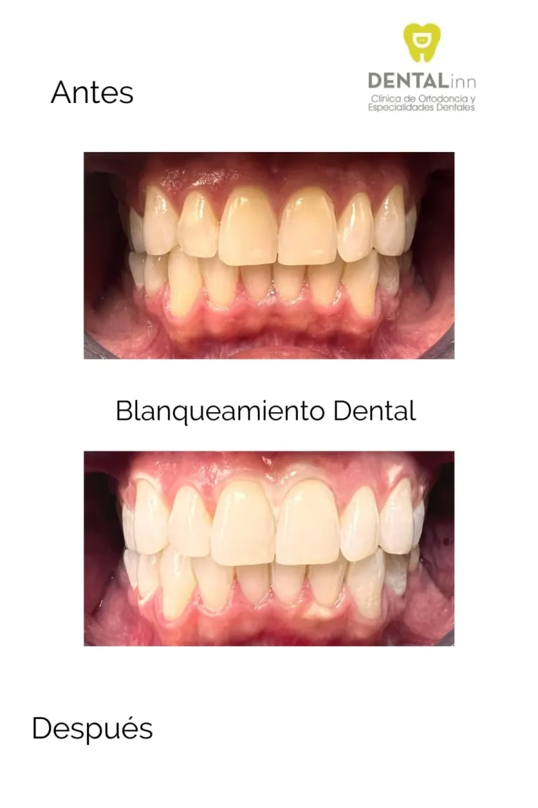 Antes y después de un blanqueamiento dental profesional