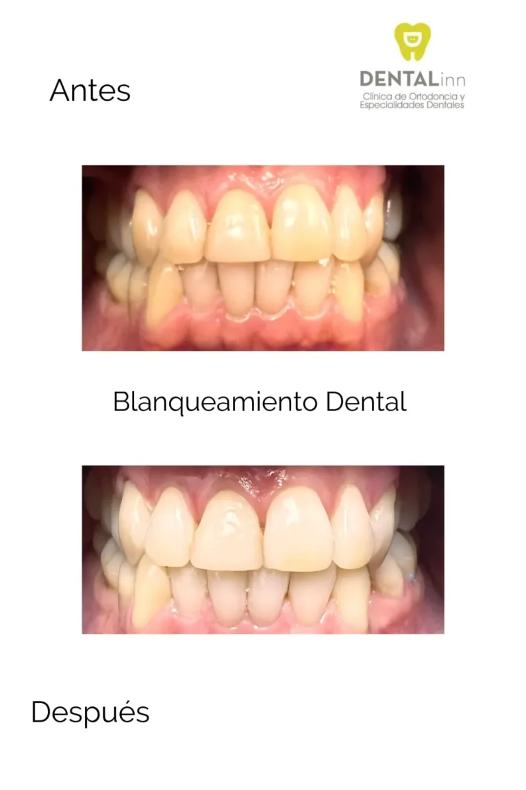 Antes y después de un blanqueamiento dental