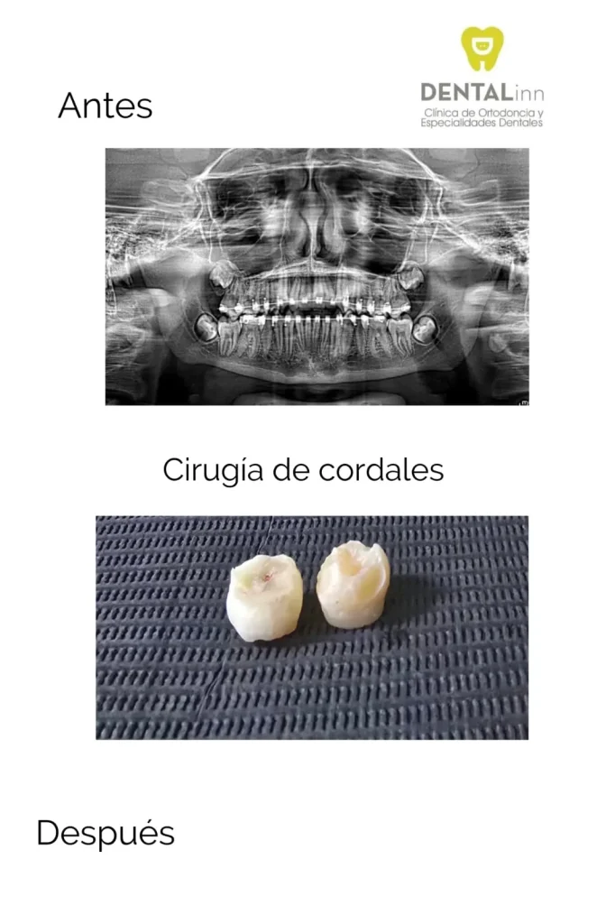 Radiografía panorámica y muelas del juicio extraídas en una cirugía de cordales