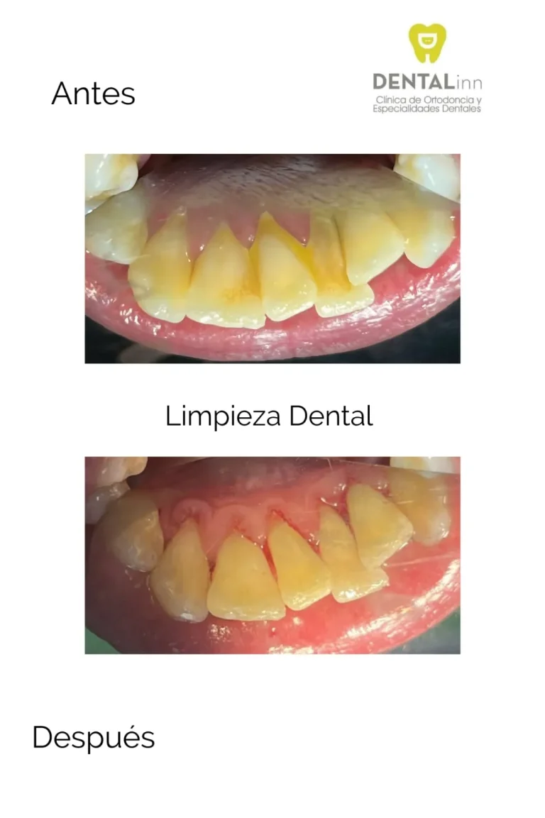 Antes y después de una limpieza dental